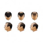 Escala de alopecia